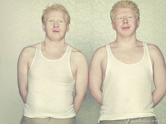 Albinizmas
