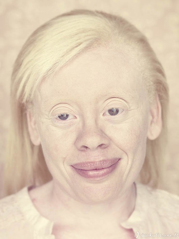 Albinizmas