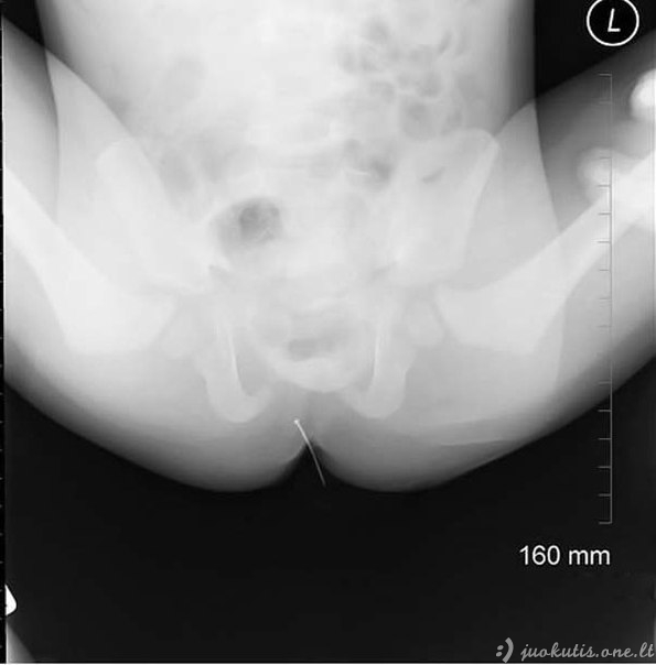 Šokiruojančios rentgeno nuotraukos