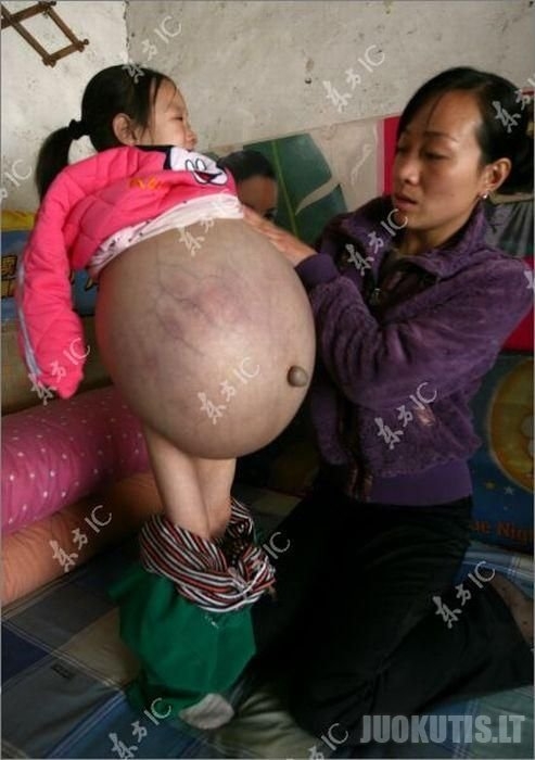 Kinijos medikai, mergaitėi pašalino didelį pilvą