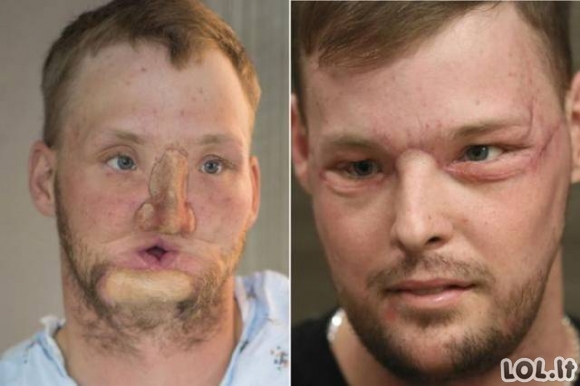 Specialistai padovanojo vyrui naują veidą ir šis po operacijos atrodo neatpažįstamai