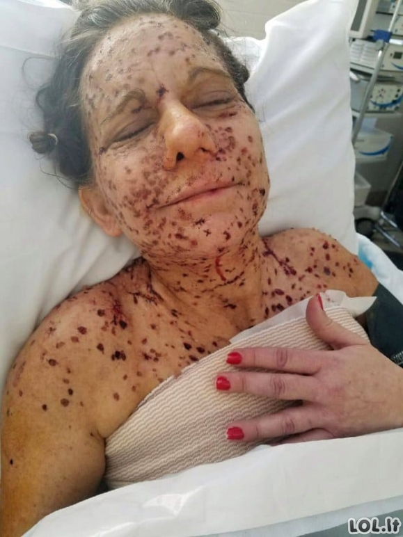 Moters veidas buvo nusėtas 6 tūkst. auglių - operacija jai suteikė naują gyvenimą
