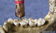 Seni dantų gydymo metodai